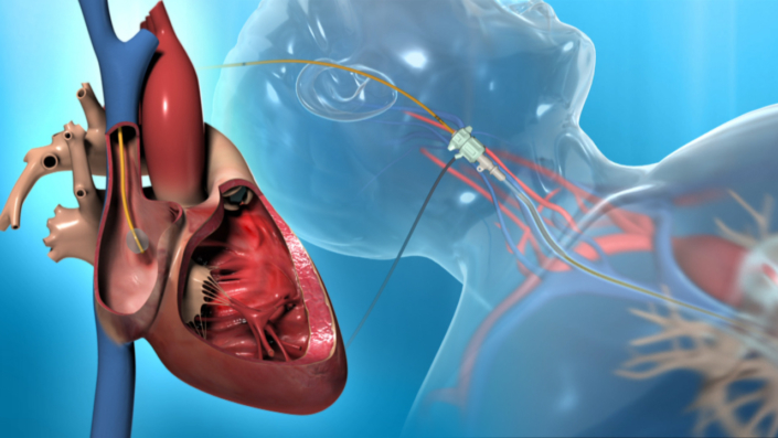 Project Right Heart Catheter