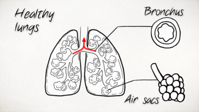 What is COPD? Animation - CAST PHARMA